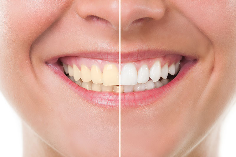 Teeth Whitening - The office of Dr. Summy Abbassi, Tarzana Dentist